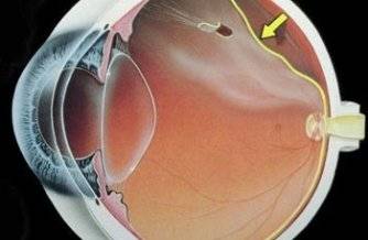 Agujero en la retina superior con separación entre la retina y la pared del ojo: desprendimiento de retina
