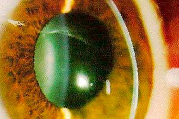 degeneración marginal pelucida en valencia - ojo degeneración marginal pelucida