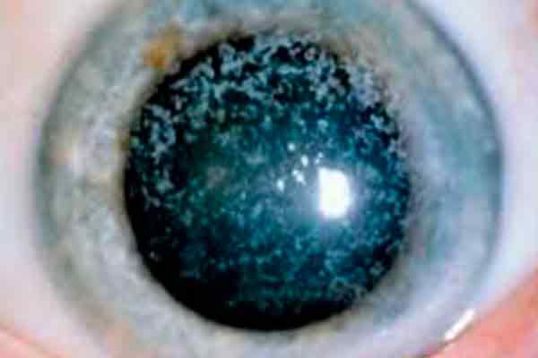 distrofias corneales en valencia - ojo distrofias corneales