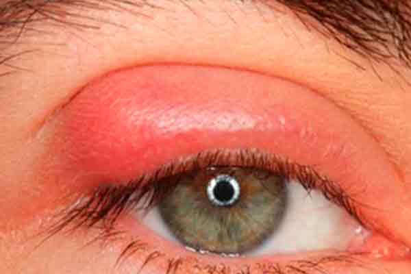 chalazion orzuelo en valencia - ojo con chalazion orzuelo