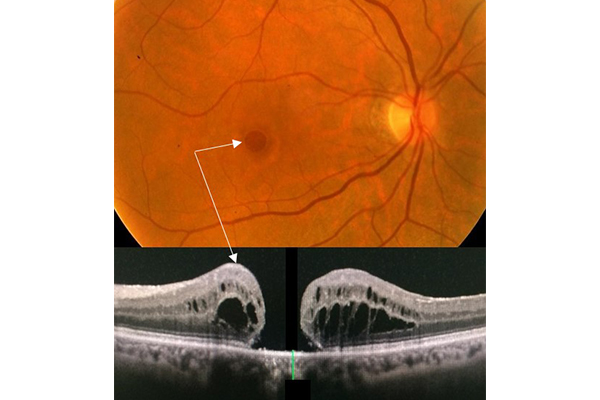 agujero macular en valencia - zoom agujero macular