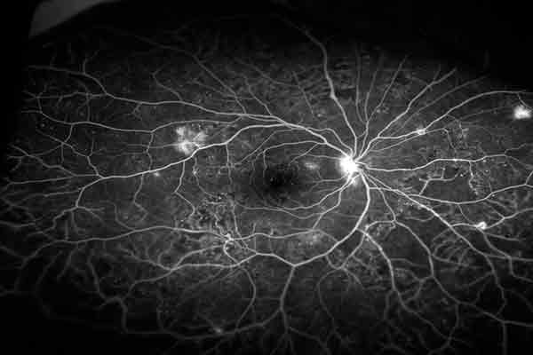 retinopatía diabética en valencia - zoom retinopatía diabética