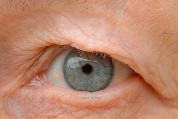 dermatocalasia en valencia - ojo dermatocalasia