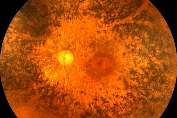 distrofias retinales en valencia - zoom distrofias retinales