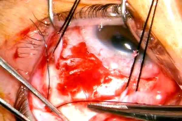 cirugía extraescleral en valencia - zoom cirugía extraescleral