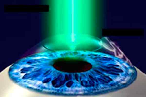 femtolasik en valencia - zoom laser