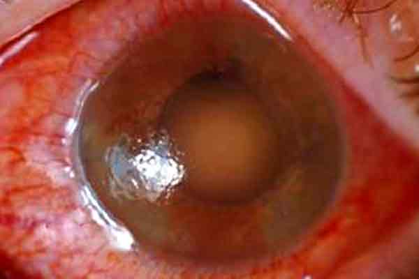 glaucoma agudo en valencia - ojo glaucoma agudo