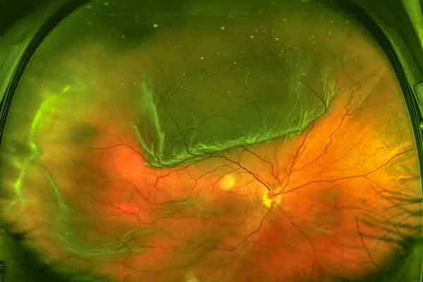 desprendimiento de retina en valencia - zoom desprendimiento de retina