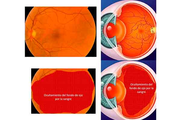 desprendimiento de retina en valencia - explicacion