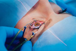 cirugía oftalmológica en Valencia - pinzas
