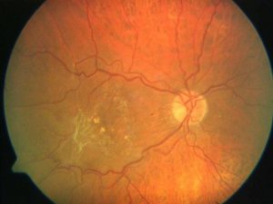 membrana epirretiniana en Valencia - ojo ampliado