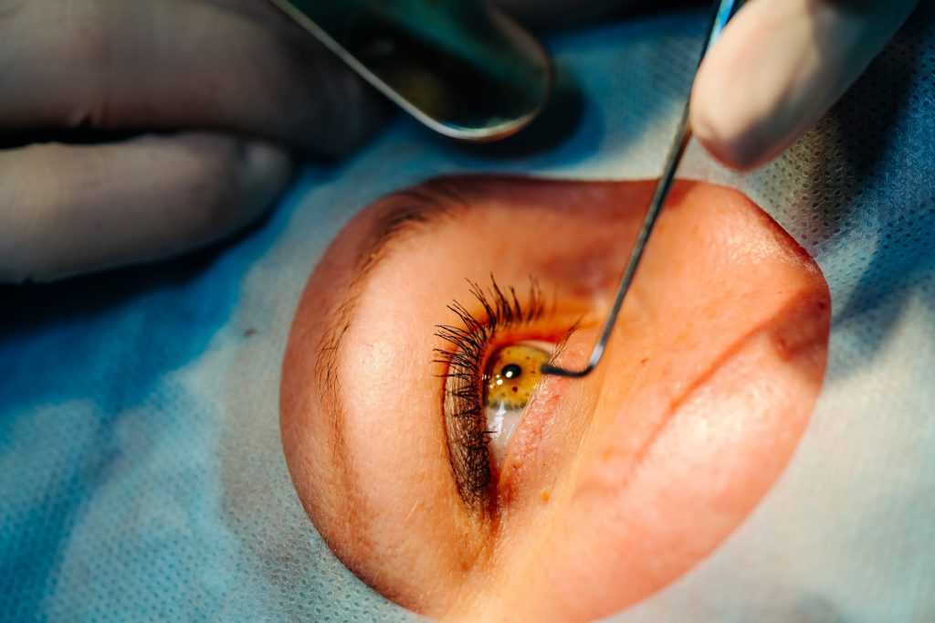cirugía oftalmológica en Valencia - luz