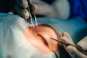 cirujanos oftalmólogos en Valencia - inicio operación