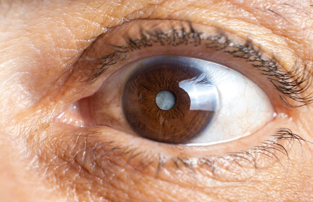 operar cataratas en valencia - ojo