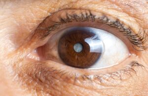 operar cataratas en valencia - ojo