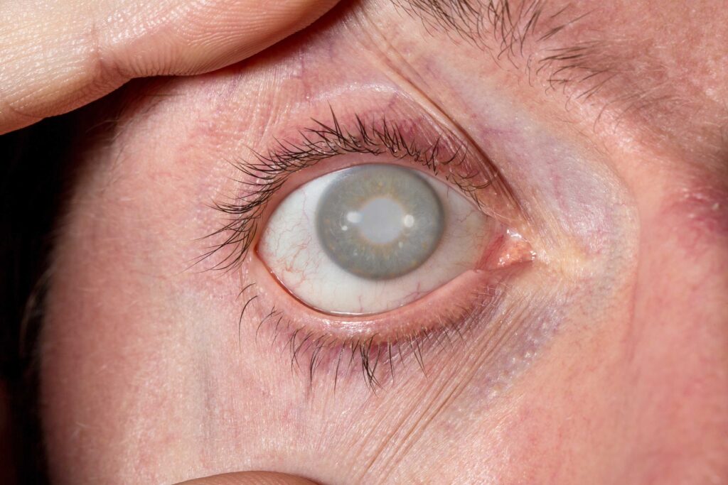 eliminar cataratas en valencia - ojo