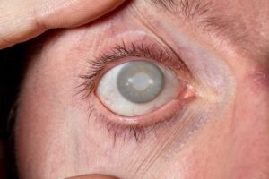 eliminar cataratas en valencia - ojo